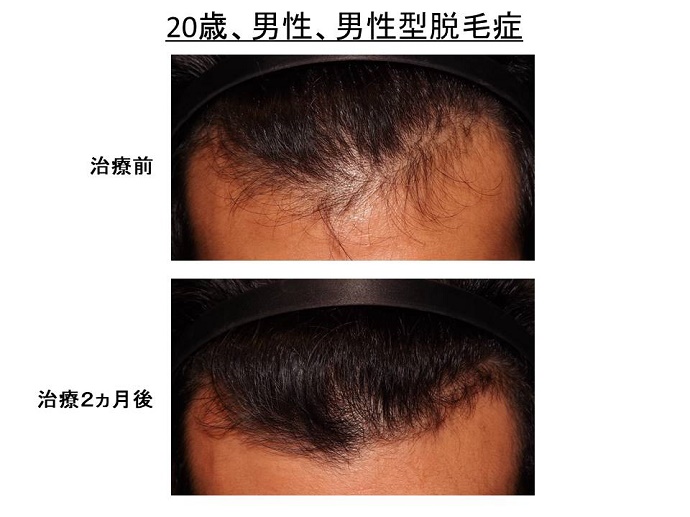 円形脱毛症　病院""